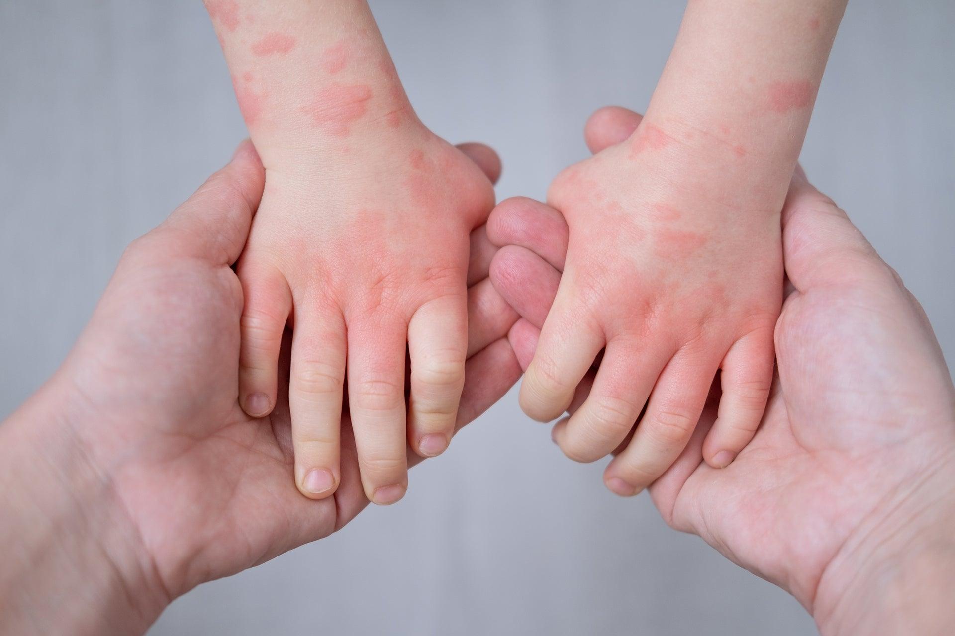 A Parent Is Holding Childs Hand That is Experiencing Eczema