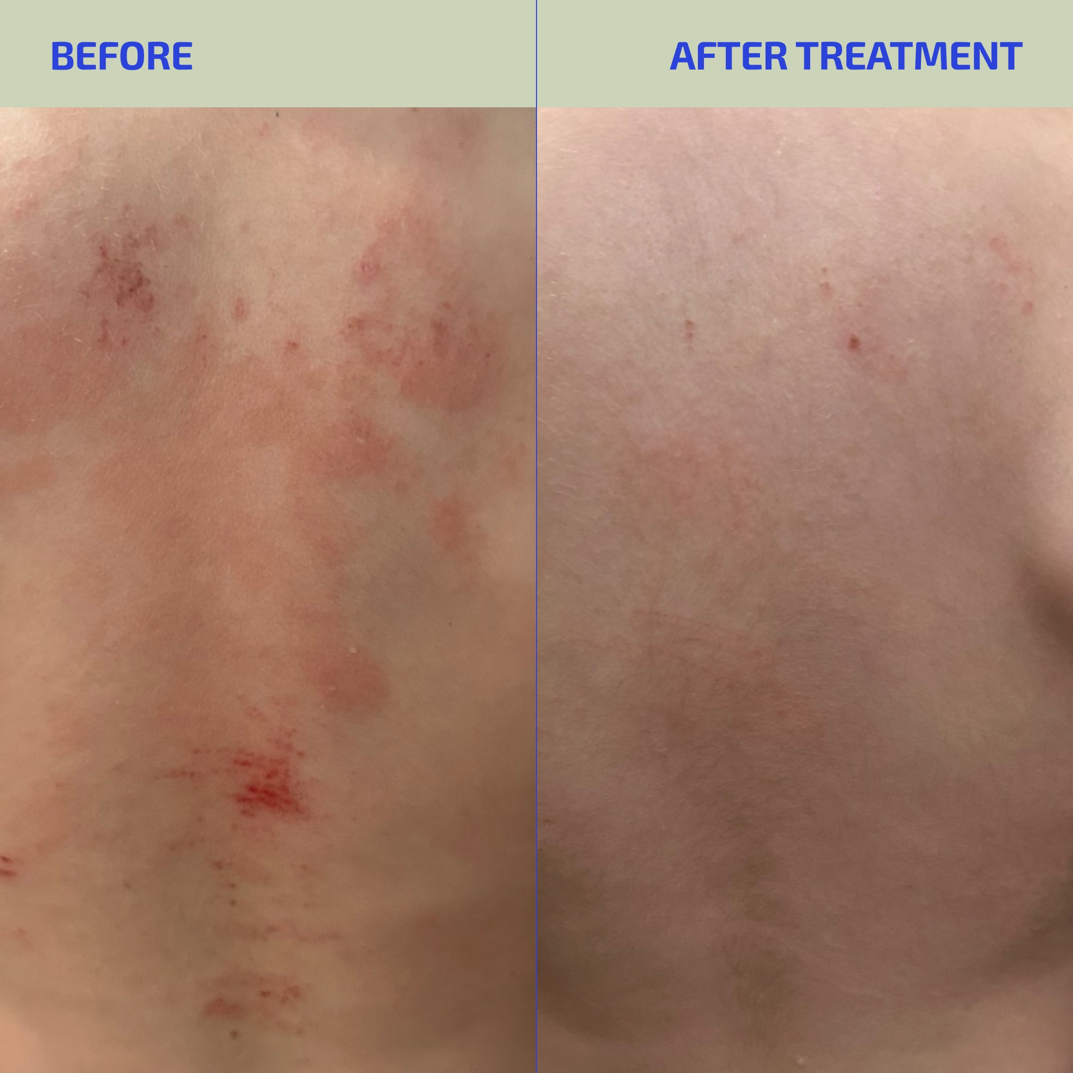 BIA ClearSkin Synbiotic Supplement for Eczema-Prone Skin