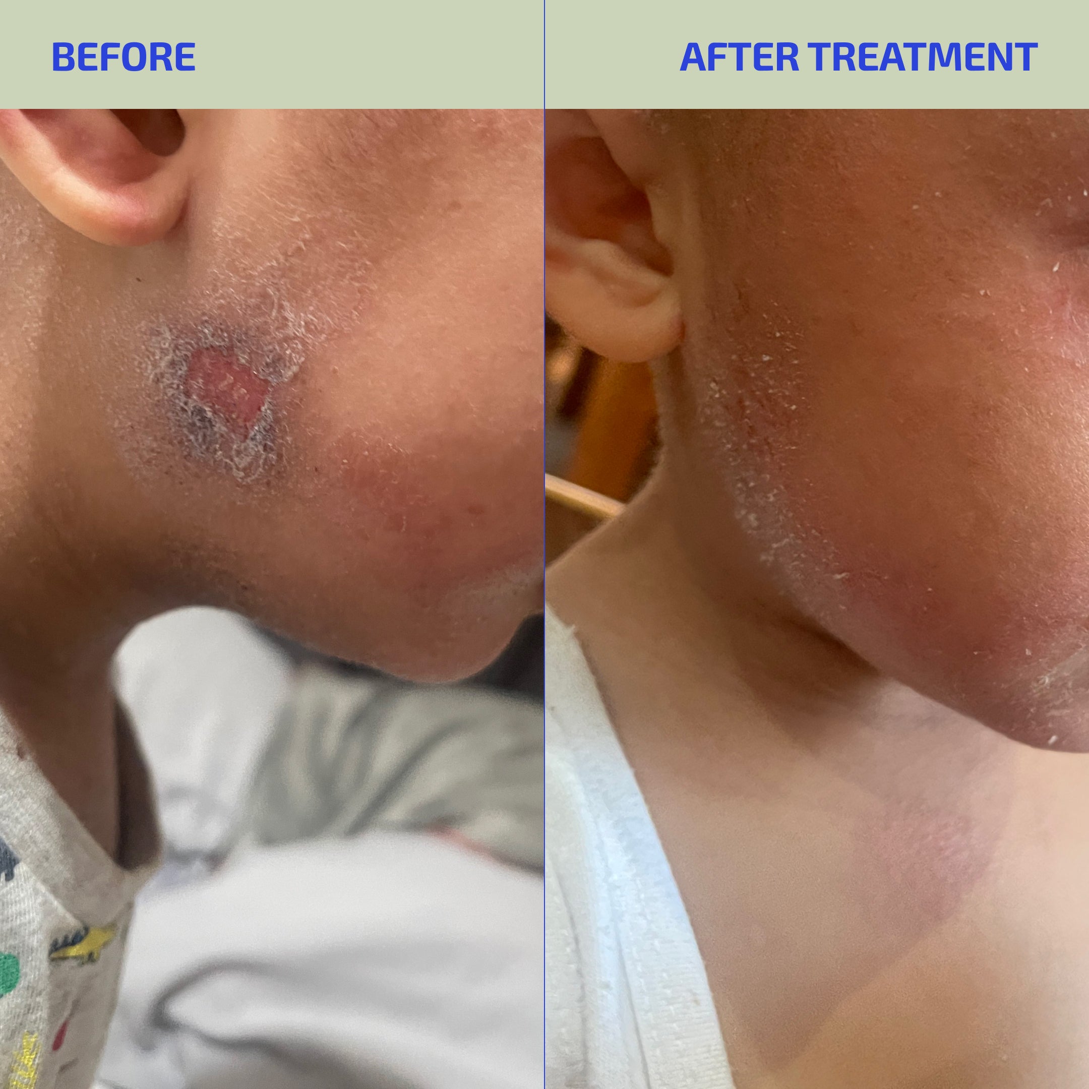 Before and after treatment comparison of a skin condition on a person's neck.