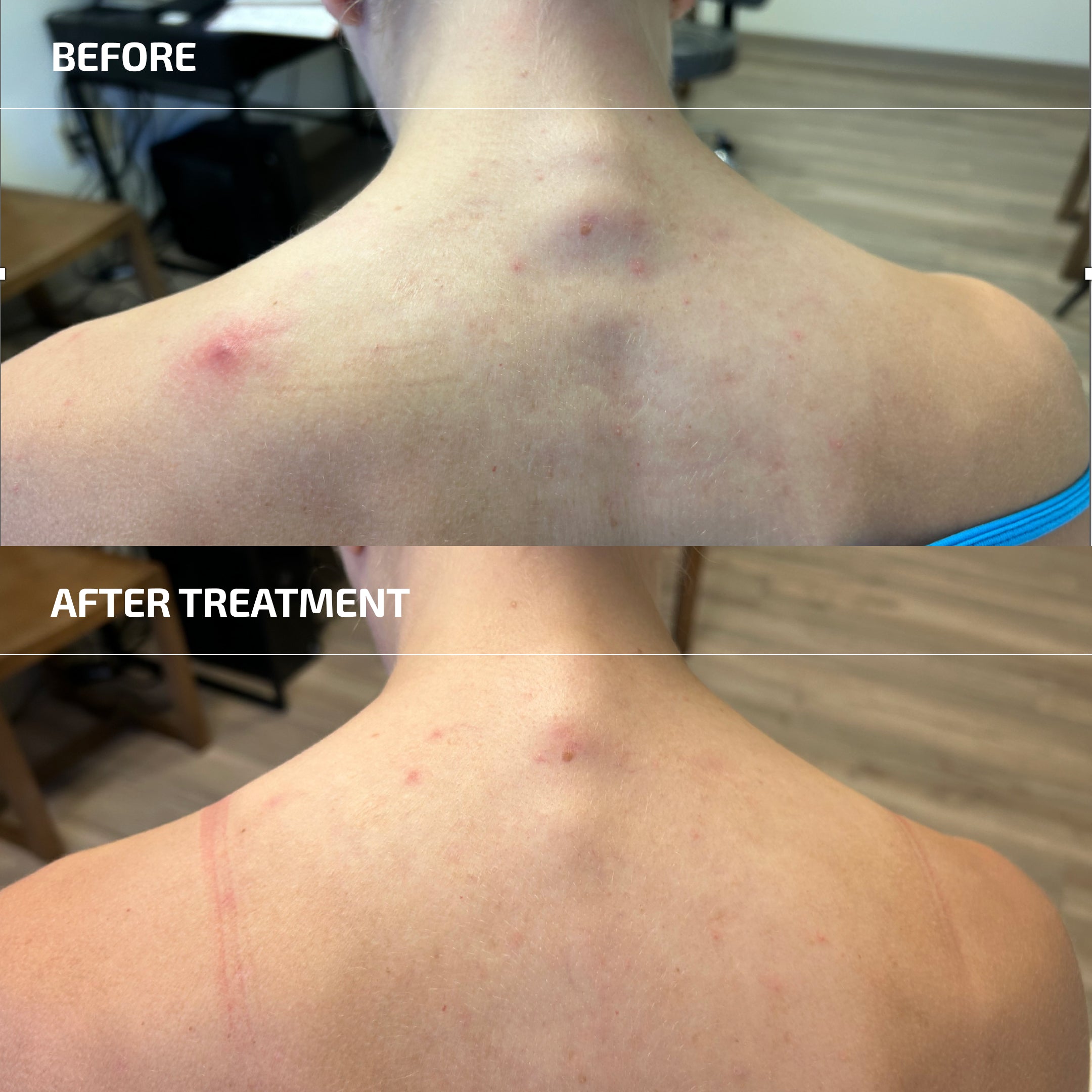 Body Acne (Bacne) System