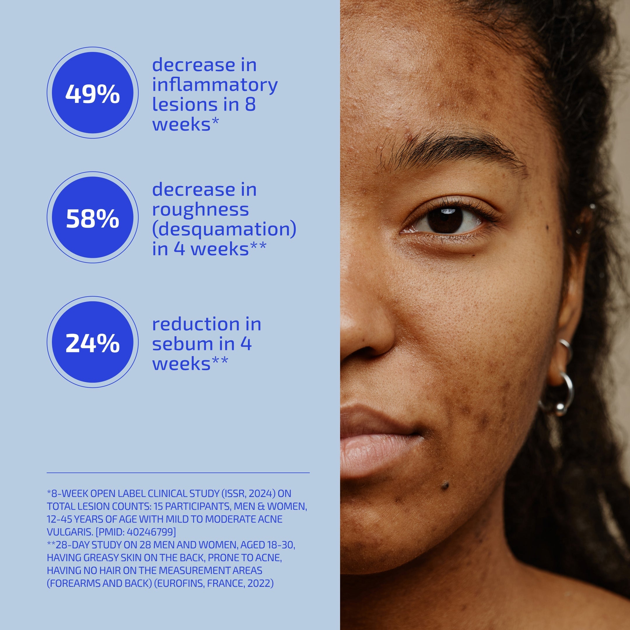 Body Acne (Bacne) System