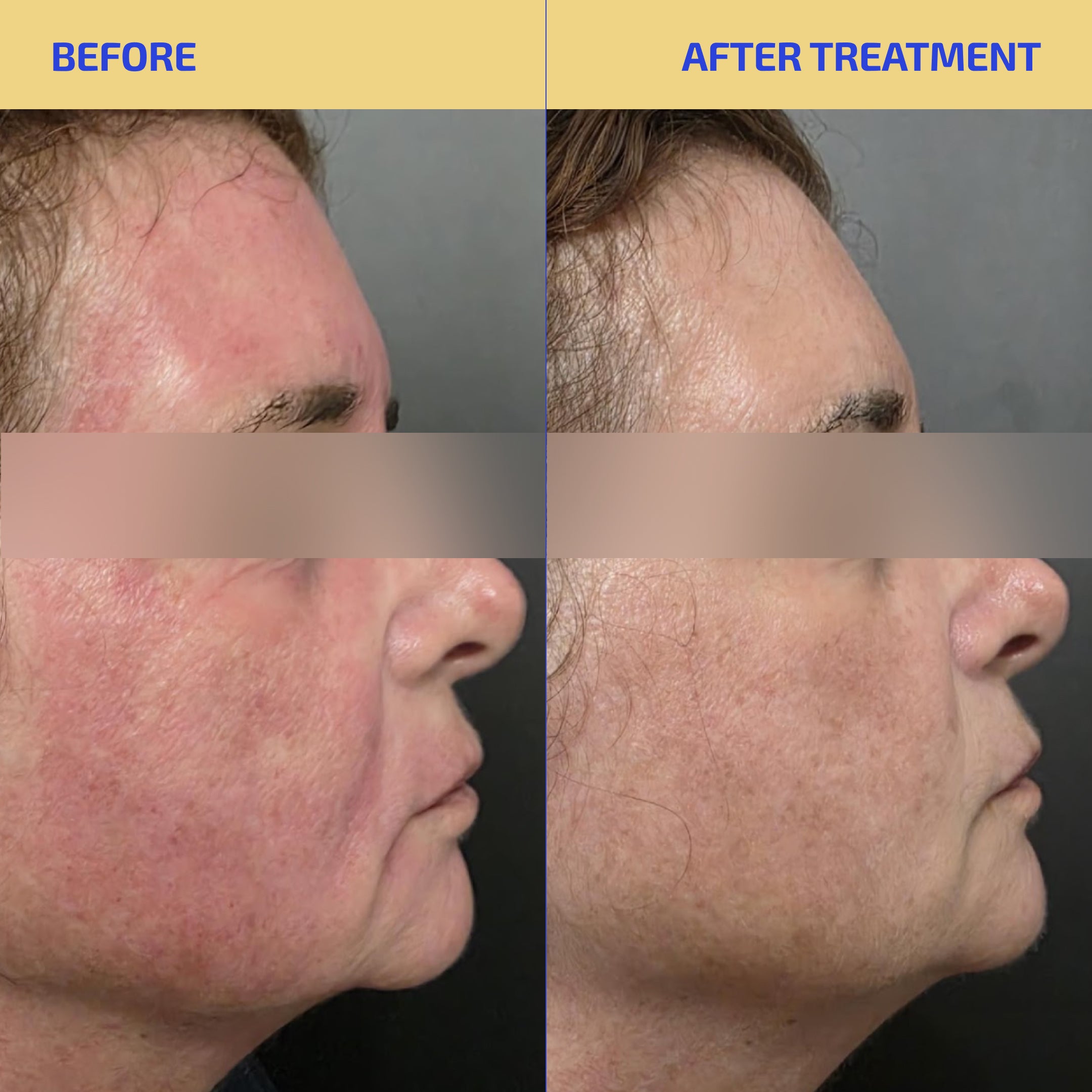 Before and after treatment comparison of a person's face with visible skin conditions.