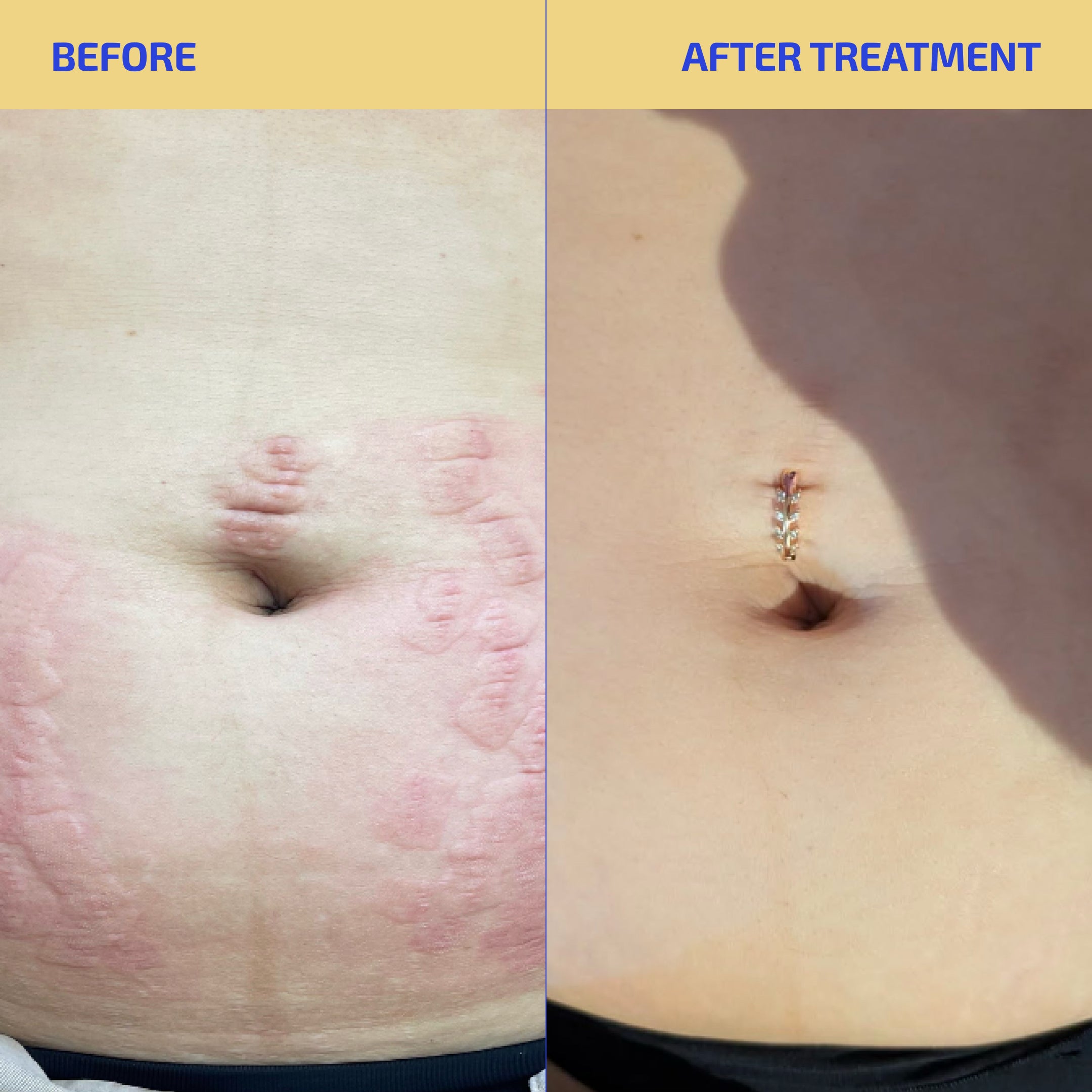 Before and after treatment comparison of a belly button with a visible ring.