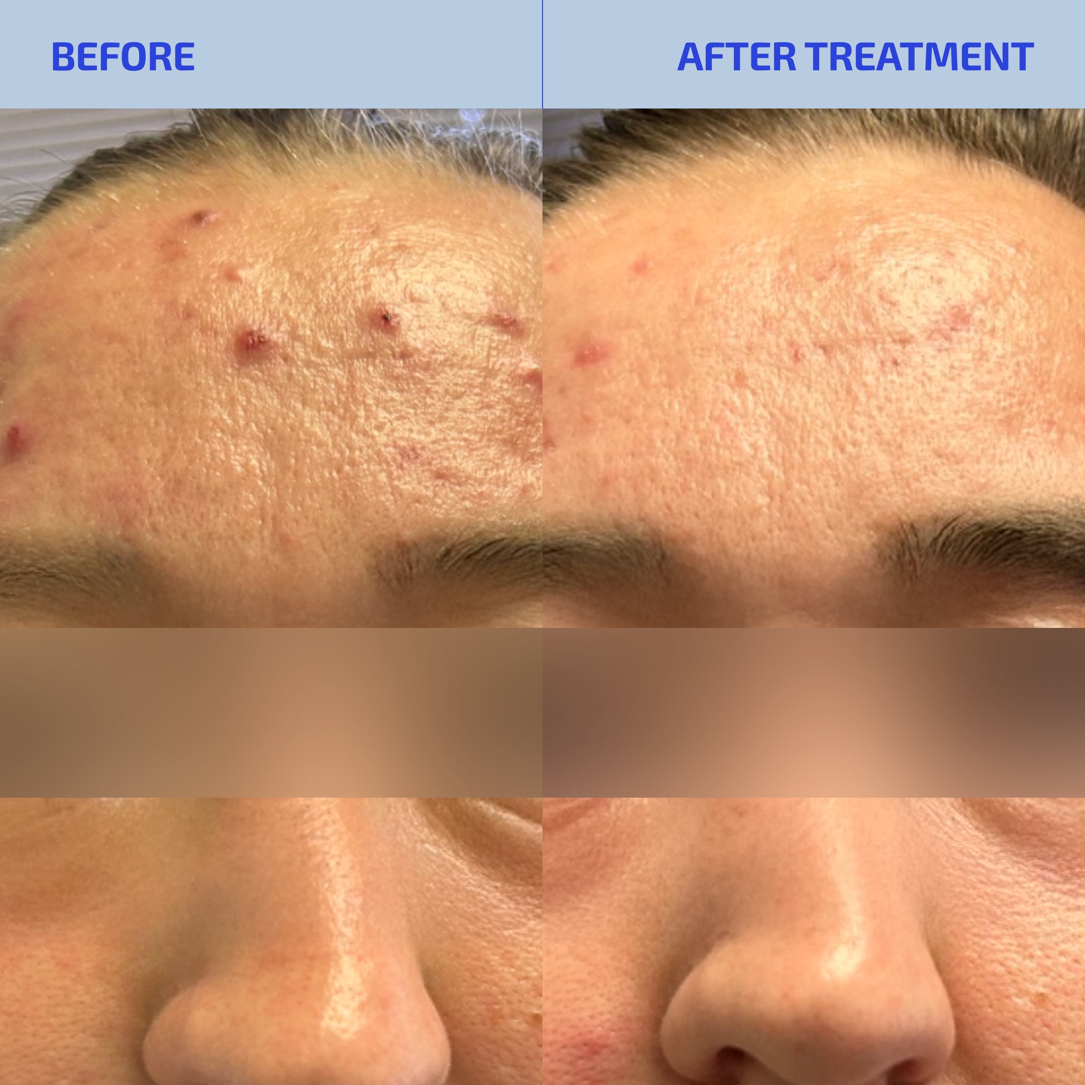 SHAANT Pore Purifying Acne Face Scrub