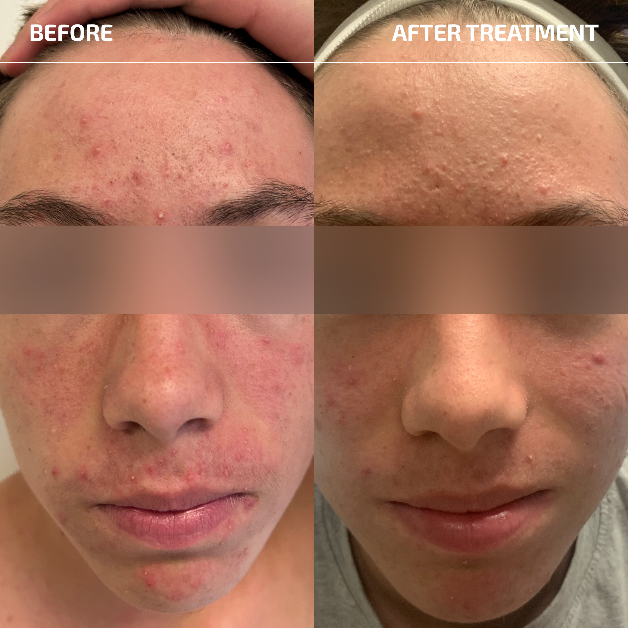 Teenage Acne System (12+ years)