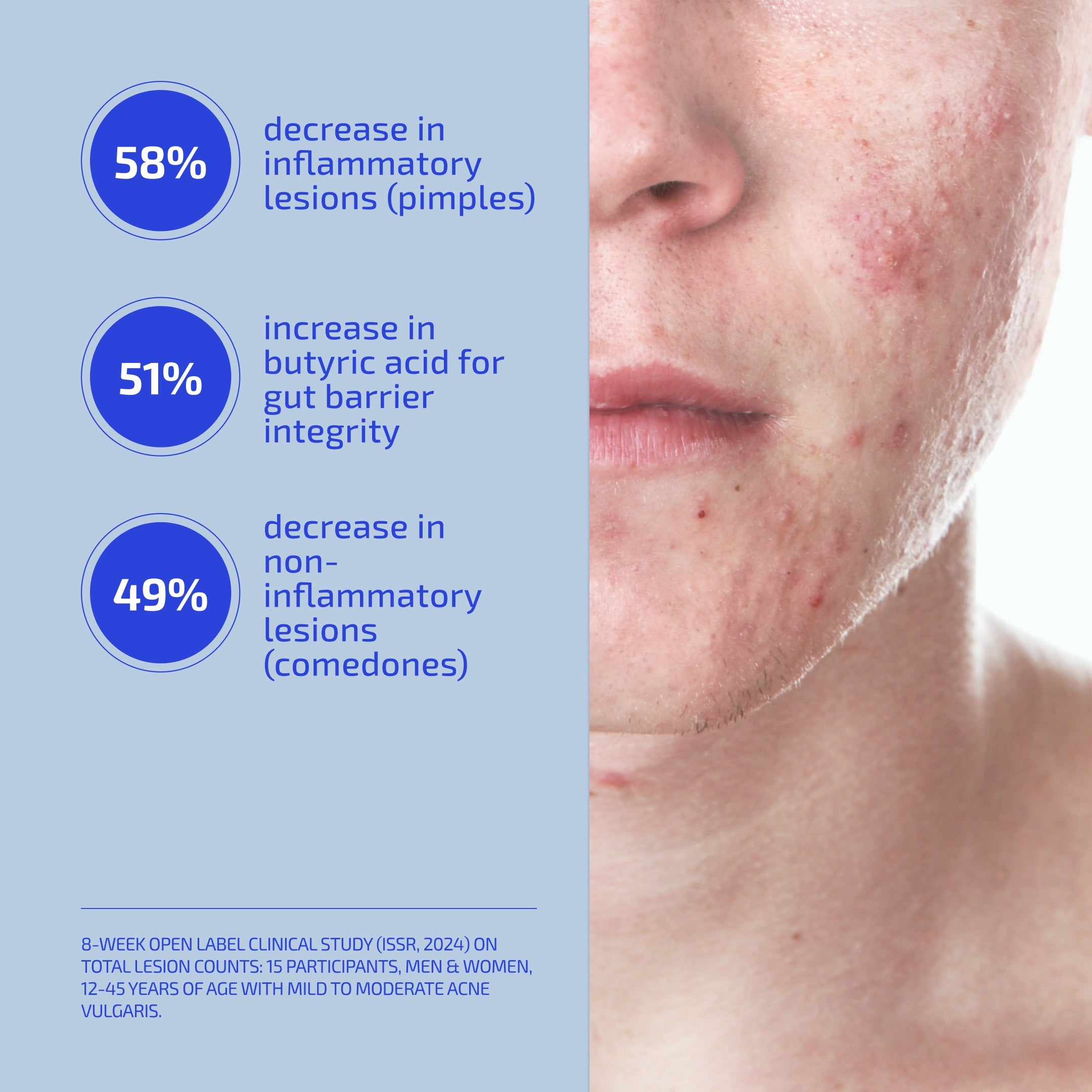 Teenage Acne System (12+ years)