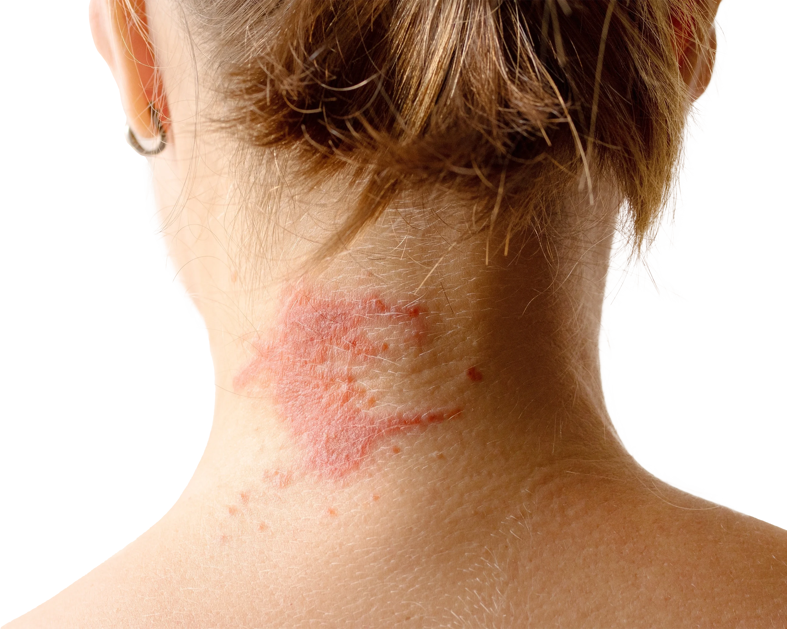 Soothe Eczema