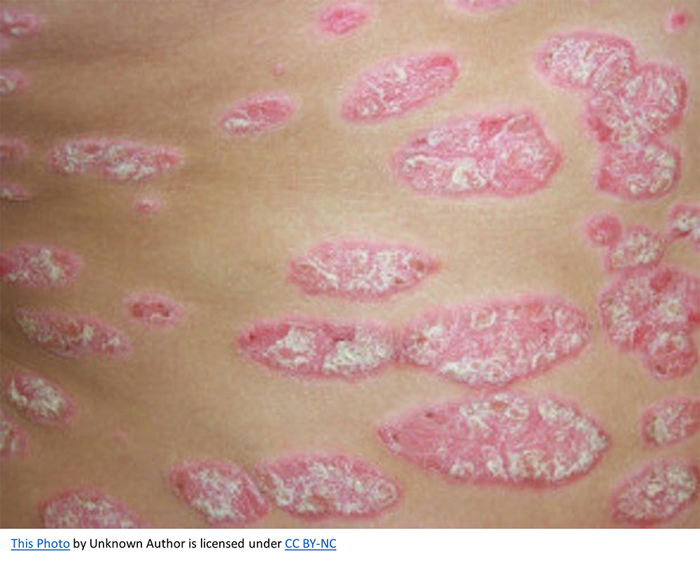 Understanding the Treatment Options for Psoriasis: Your Guide to Healthier Skin