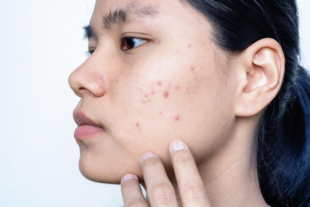 Close up Image of a woman with acne on her cheek as she touches it with concern