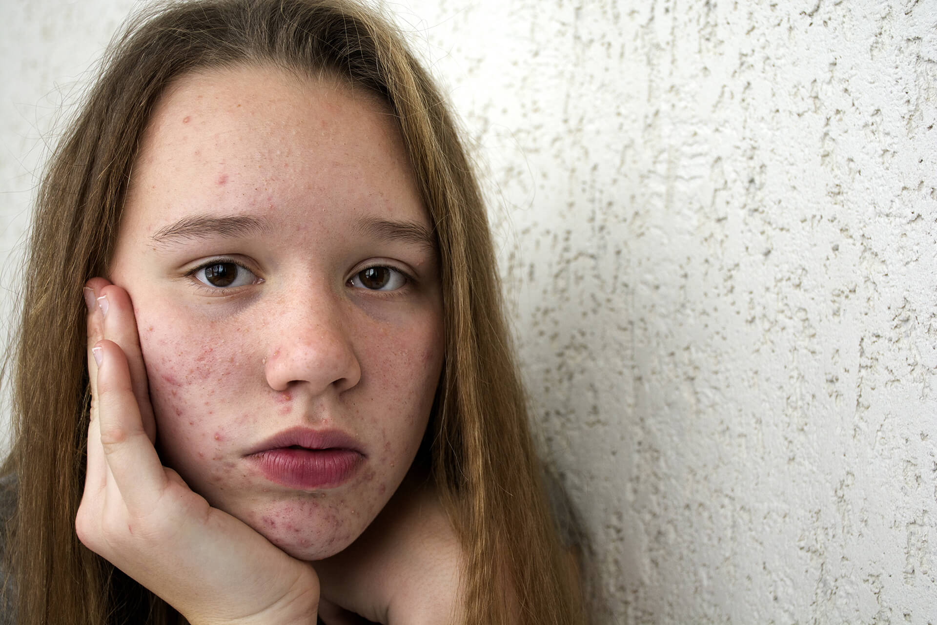 A Guide to Teenage Acne: Causes, Treatments, and Prevention