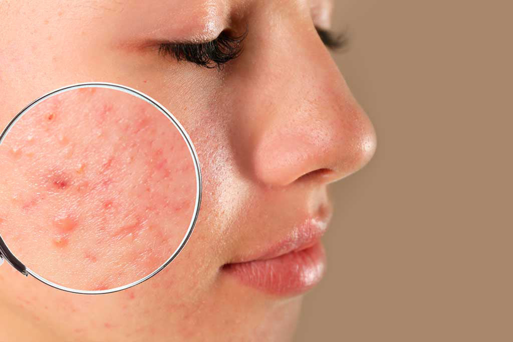 HOW TO TELL IF ACNE IS HORMONAL OR BACTERIAL