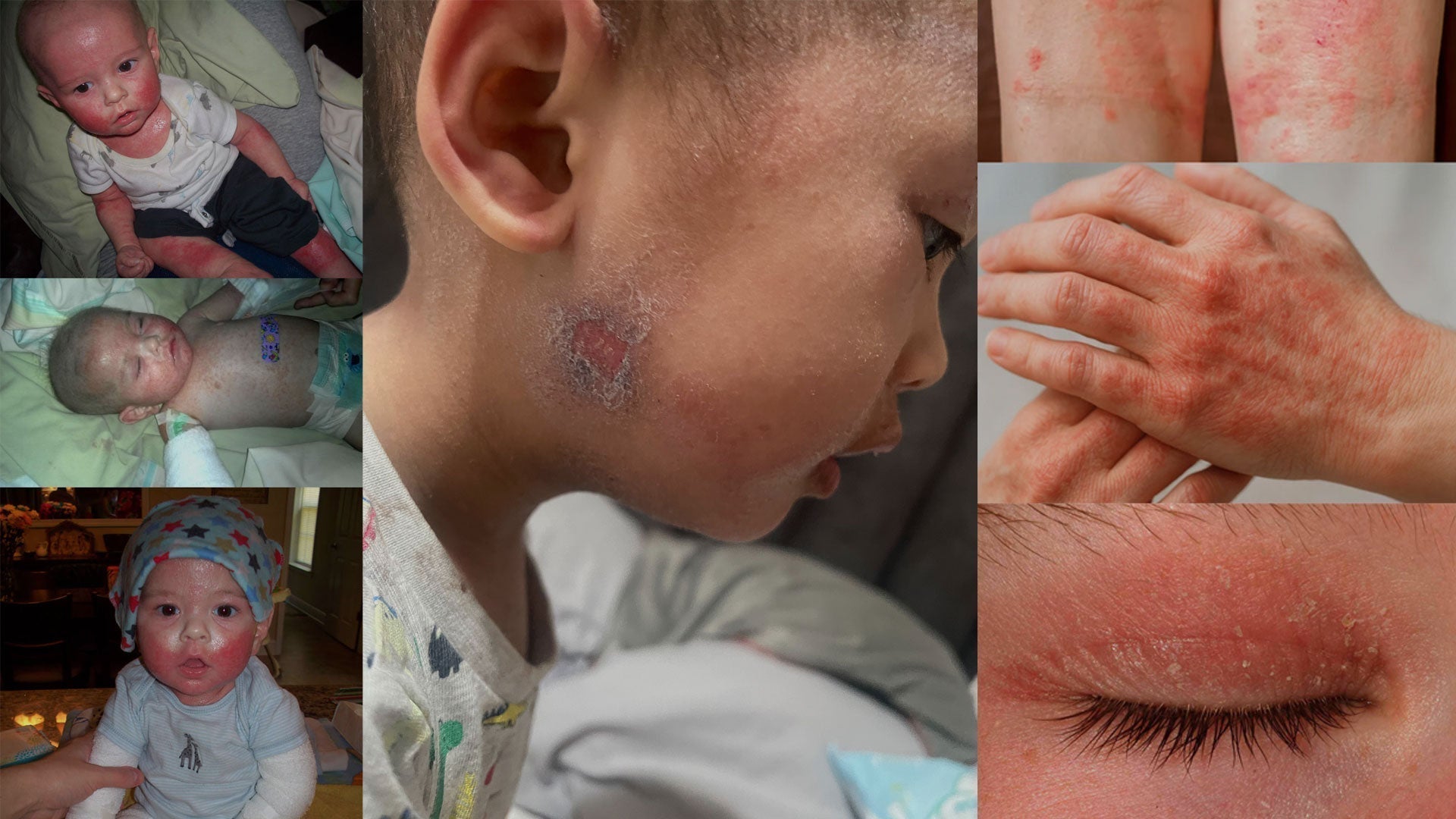 Topical Steroid Withdrawal (TSW): Why It's Suddenly Everywhere