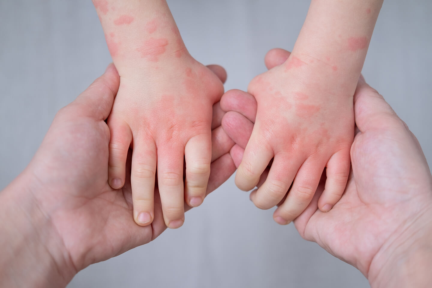 ECZEMA on hands