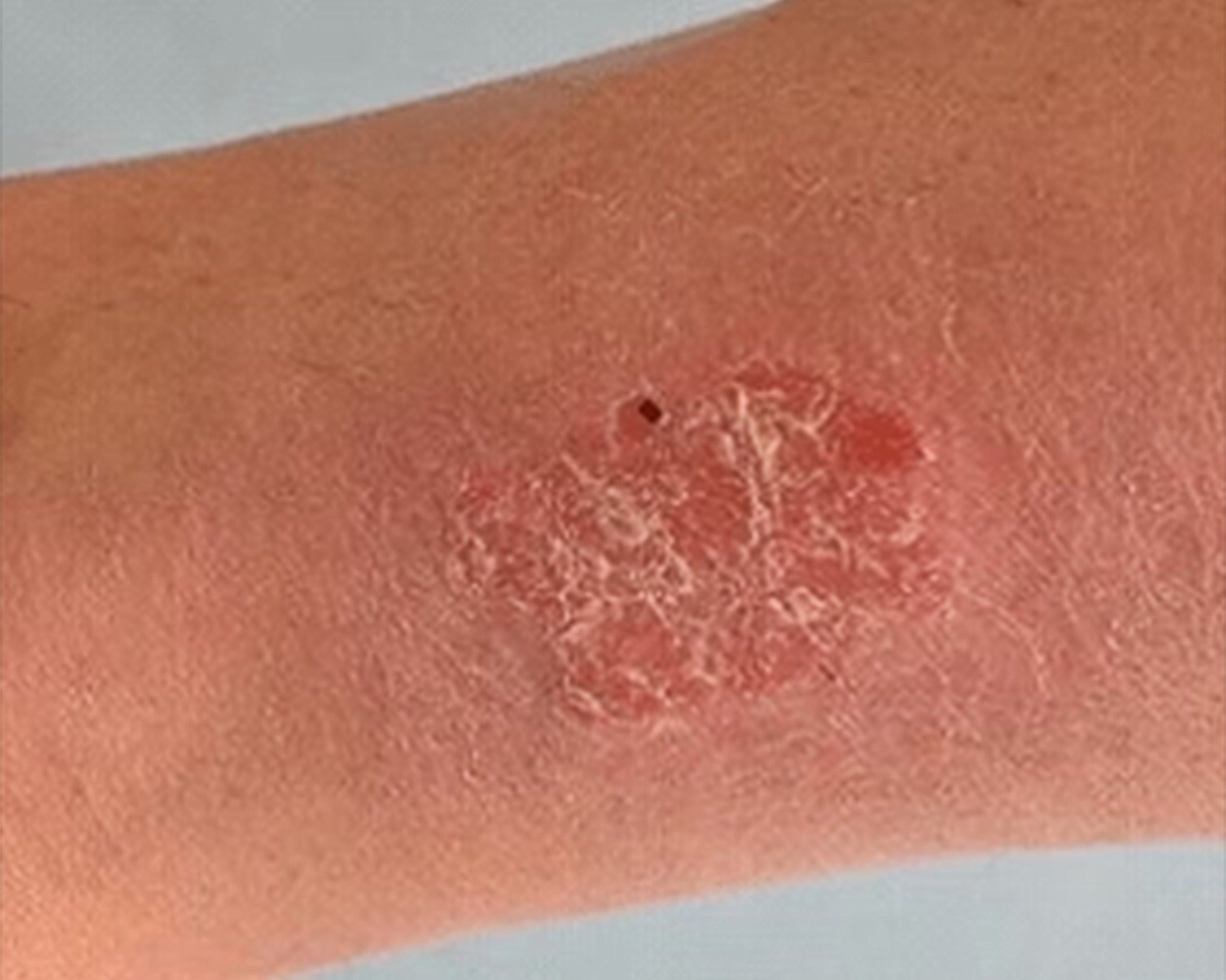 Psoriasis on an arm.