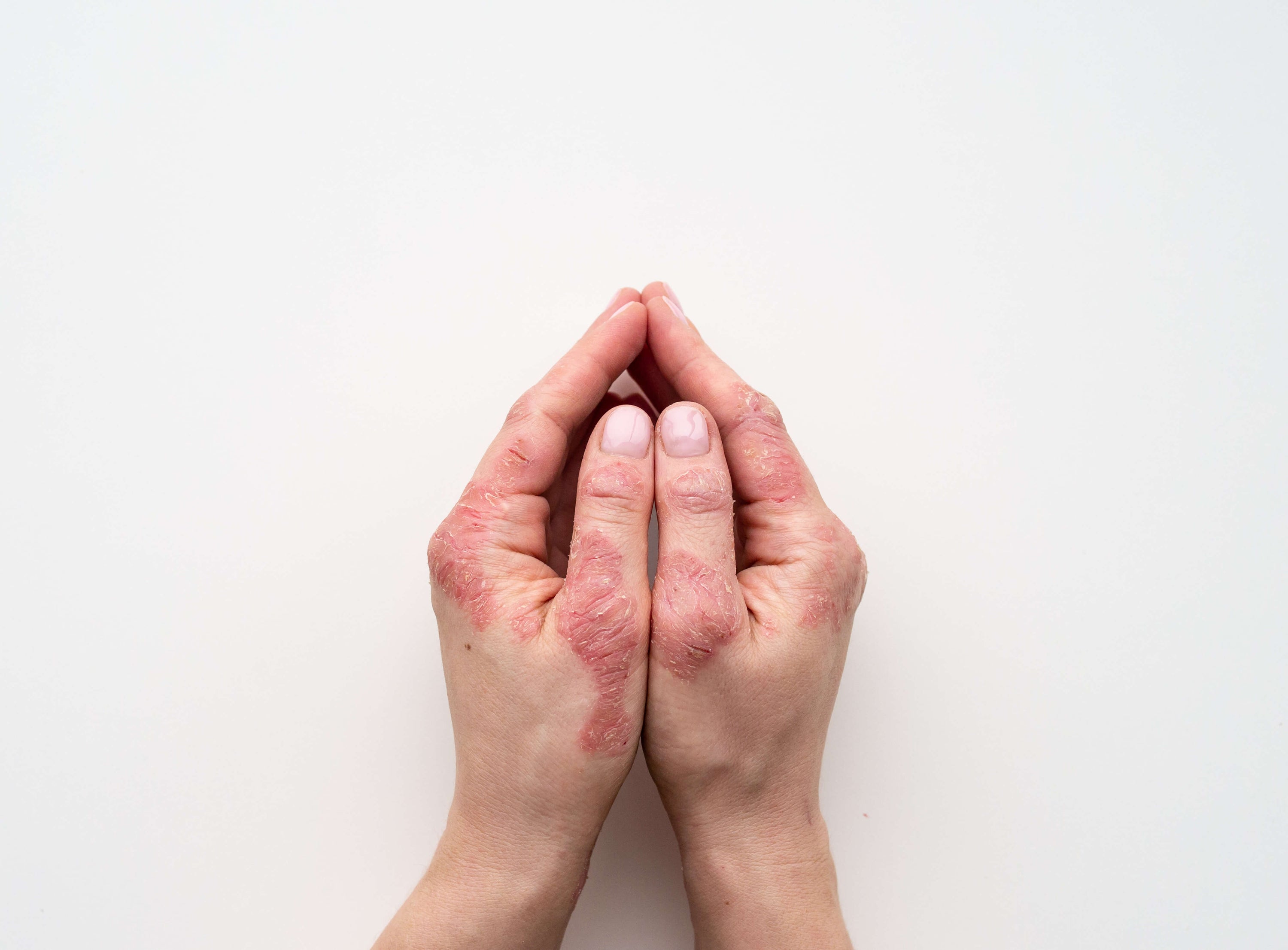 Hands with psoriasis.