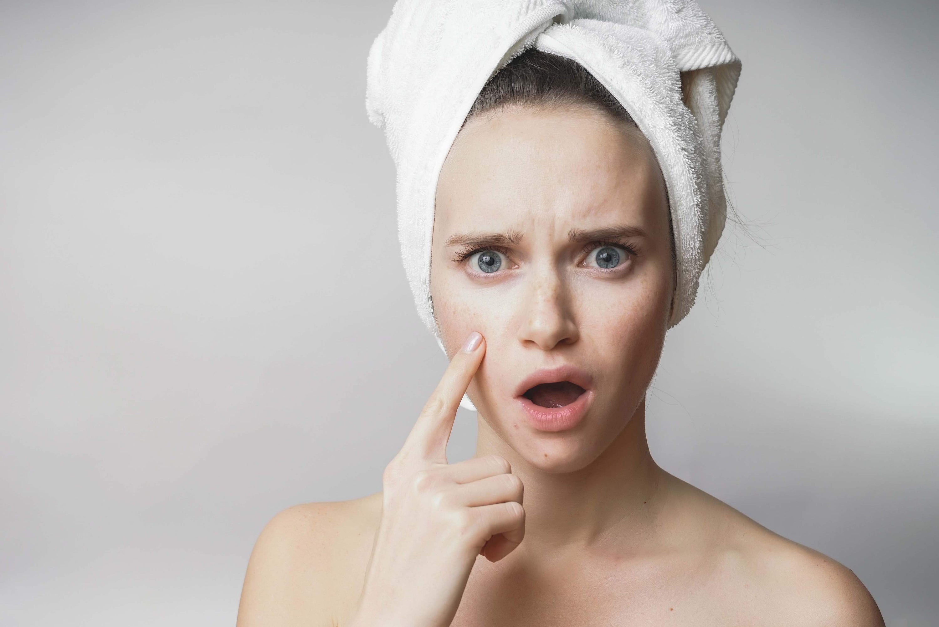 Woman with a white towel on her head is looking at her acne, and worrying about it.