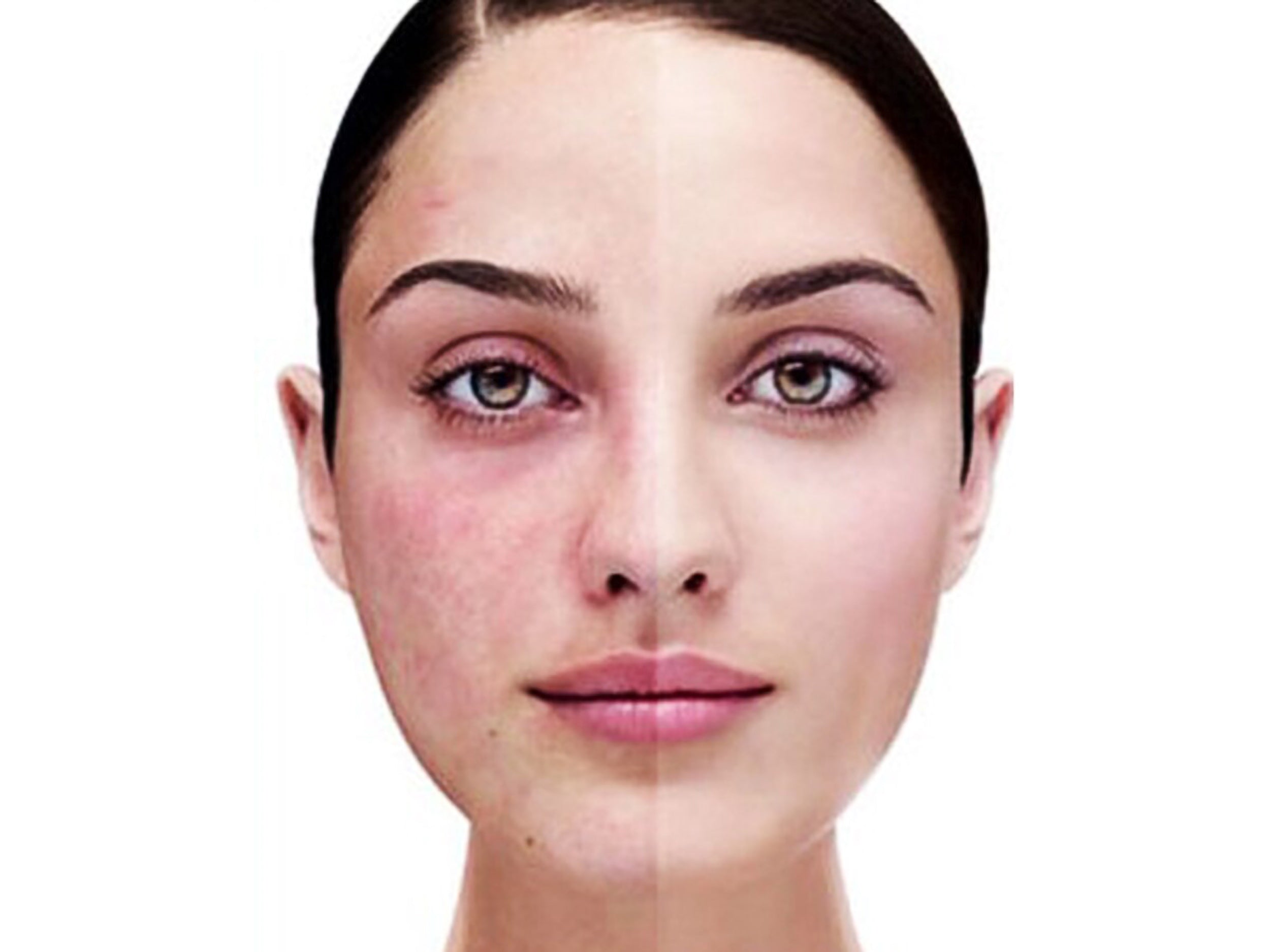 DOES ROSACEA HAVE YOU SEEING RED? – Codex Labs Corp
