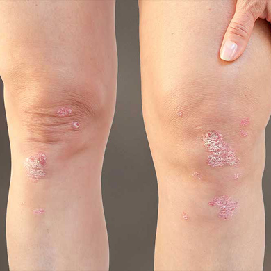 Psoriasis– Codex Labs Corp