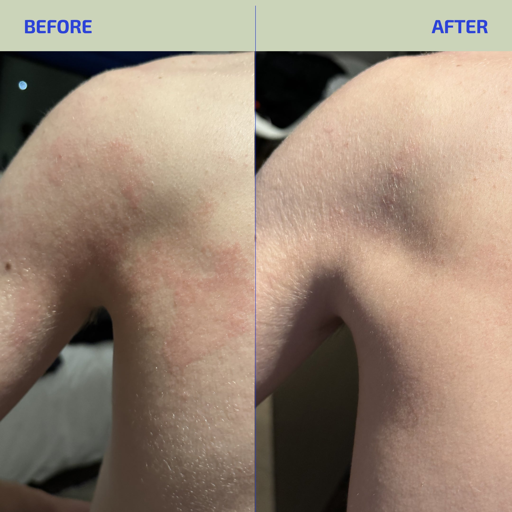 BIA ® Eczema Essentials Duo