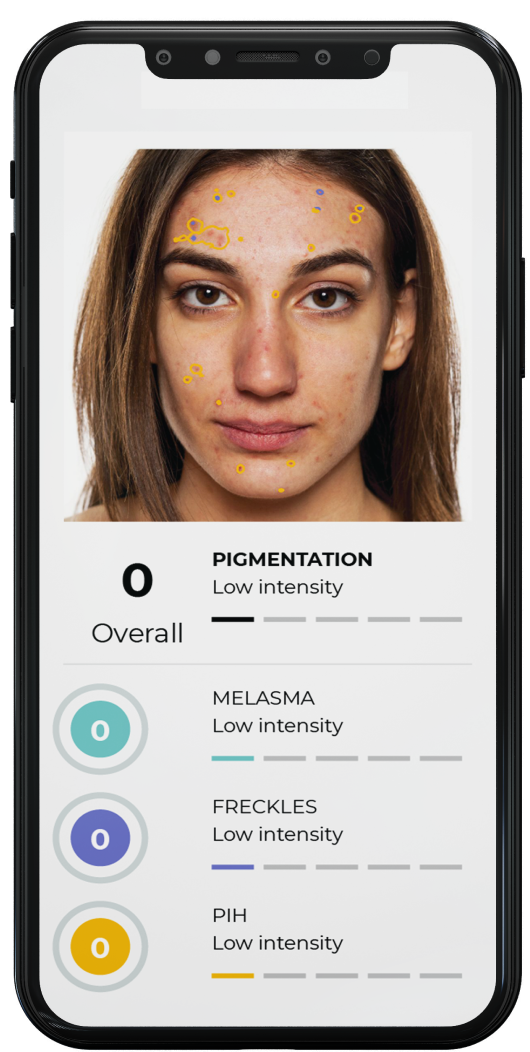 Image of a cell phone displaying a person's skin results from the Dermscore app.