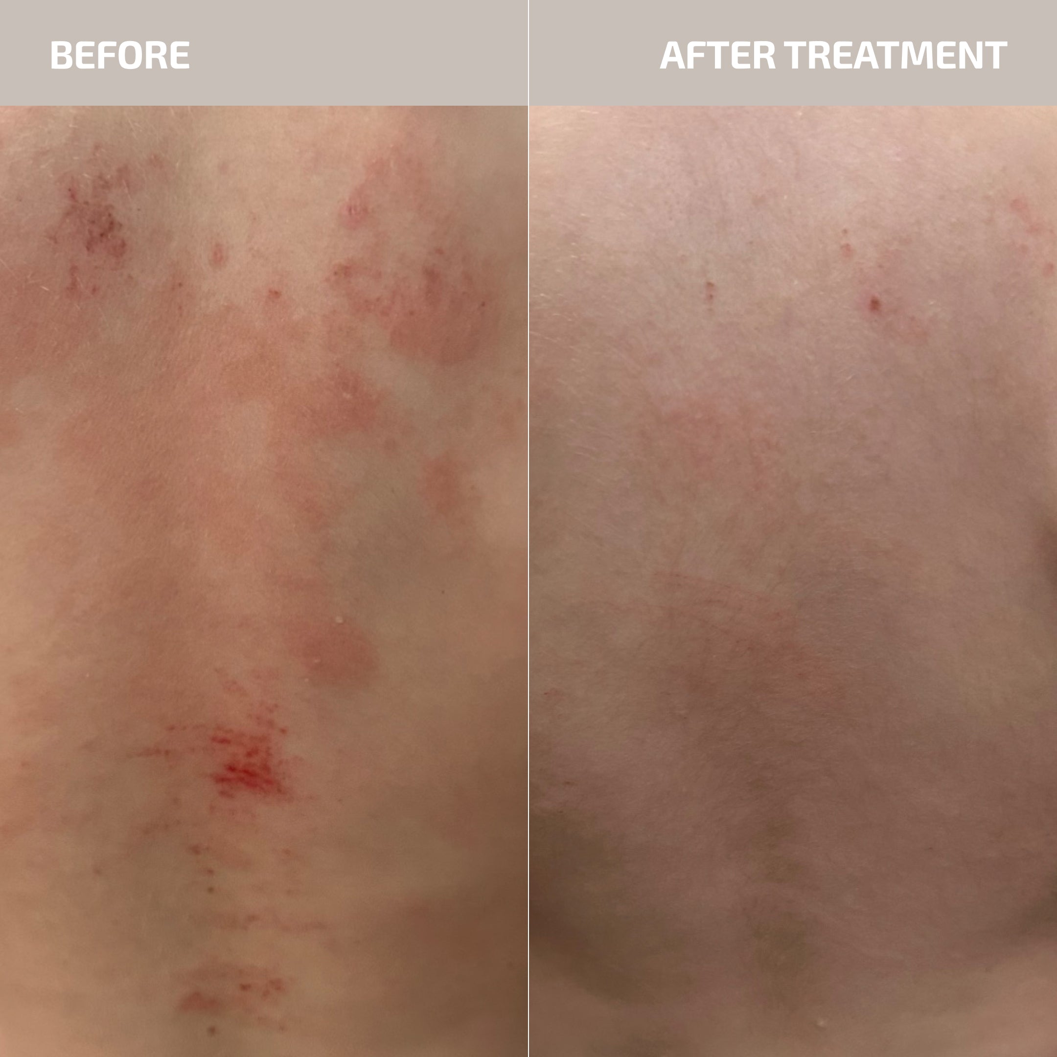 ANTÜ Skin Barrier Support Supplement