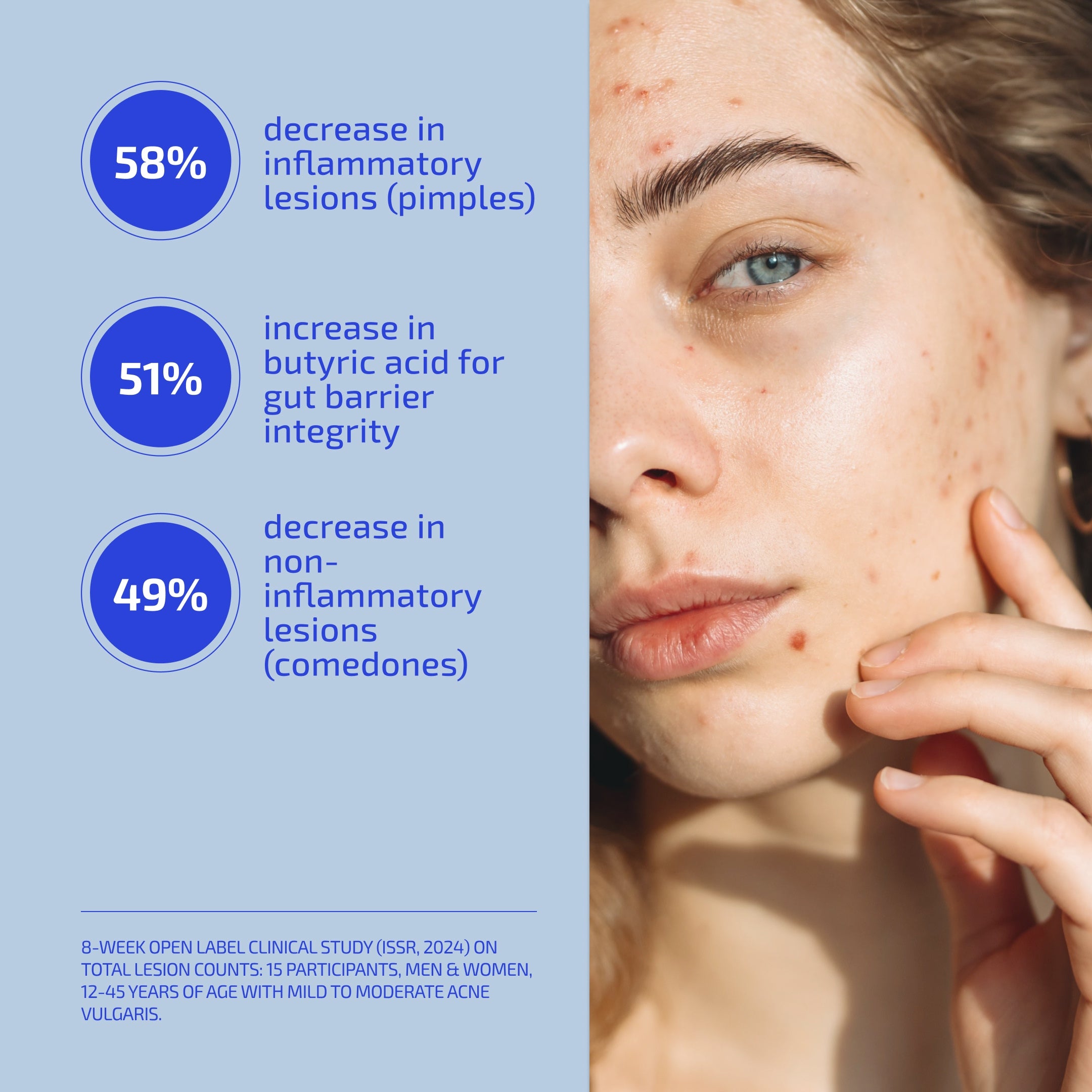 ADVANCED ACNE SYSTEM (60-DAY)
