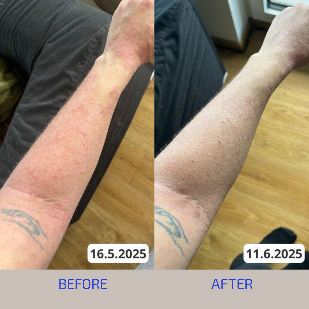 Adult Eczema & Flare Relief - 30-Day Skin Barrier Protocol: Glycerin Soap, Lotion & L-histidine Supplement (Age: 18+) Adult Eczema & Flare Relief - 30-Day Skin Barrier Protocol: Glycerin Soap, Lotion & L-histidine Supplement (Age: 18+)