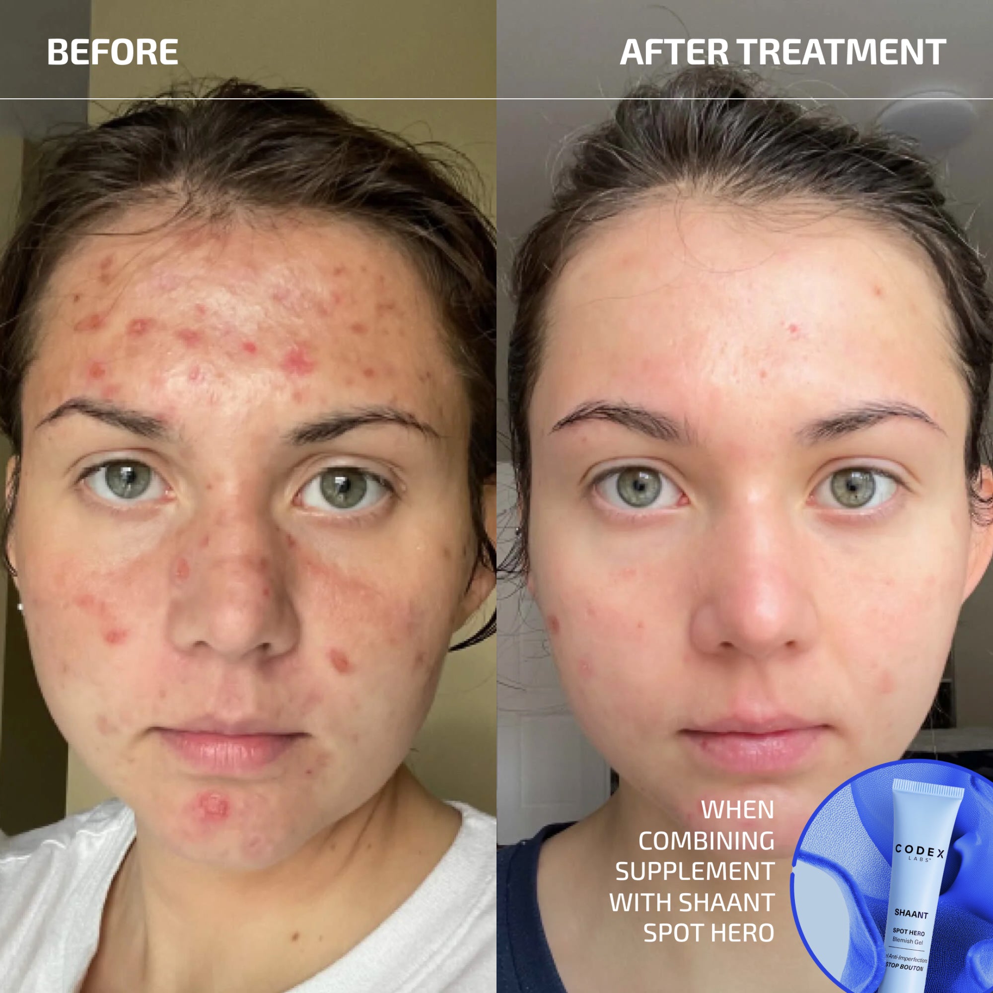 SHAANT ® ClearSkin Probiotic Supplement 2.0