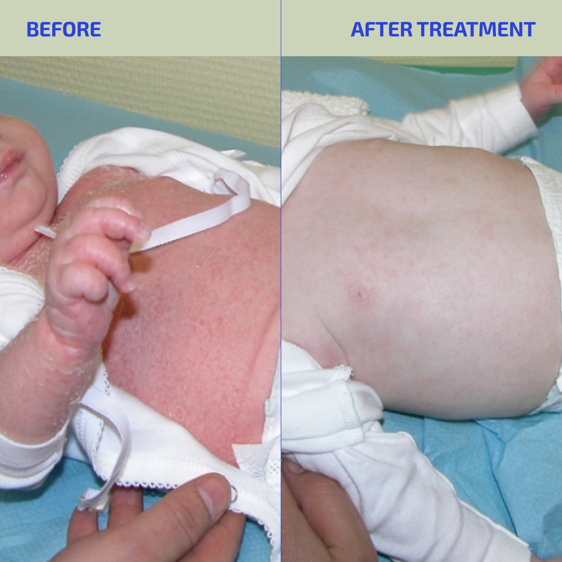 Skin Barrier Eczema Relief System (Toddler: 1-3)
