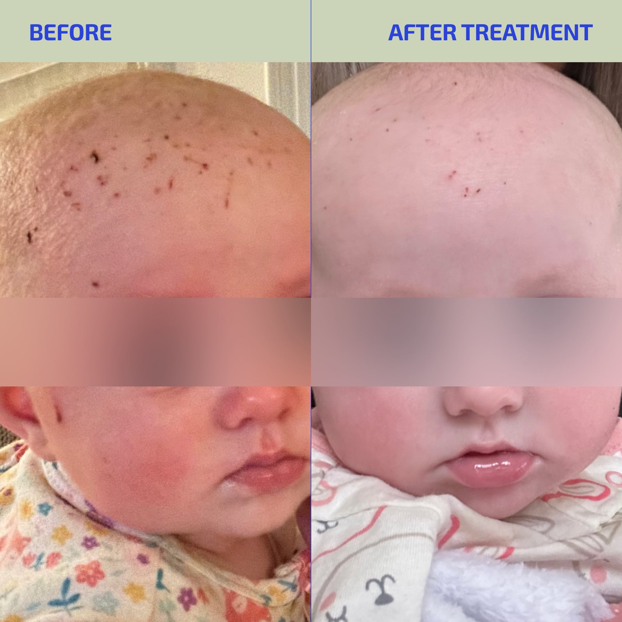 Skin Barrier Eczema Relief System (Infant: 3-12 months)
