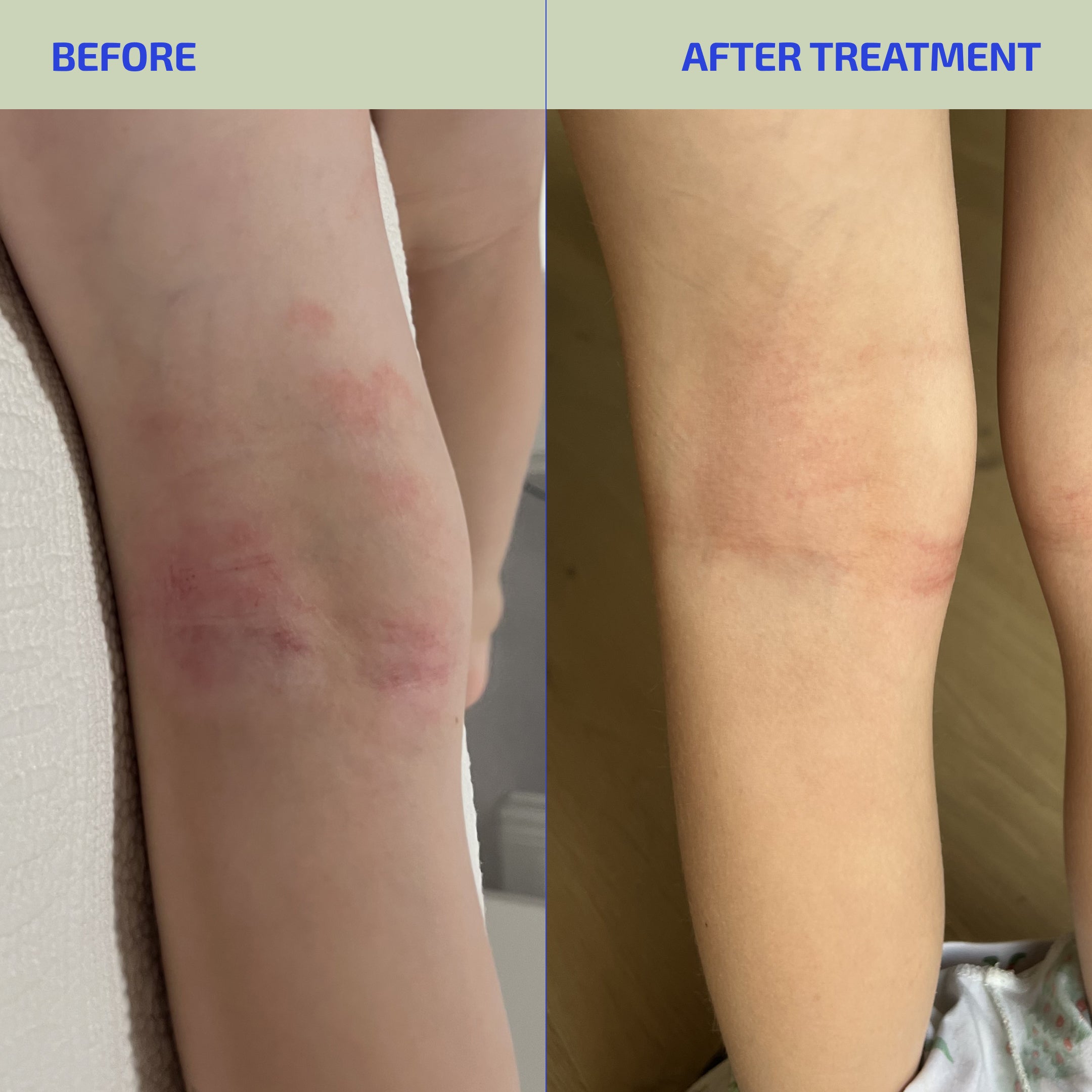 Skin Barrier Eczema-Prone Relief System (Kids: 4-12)