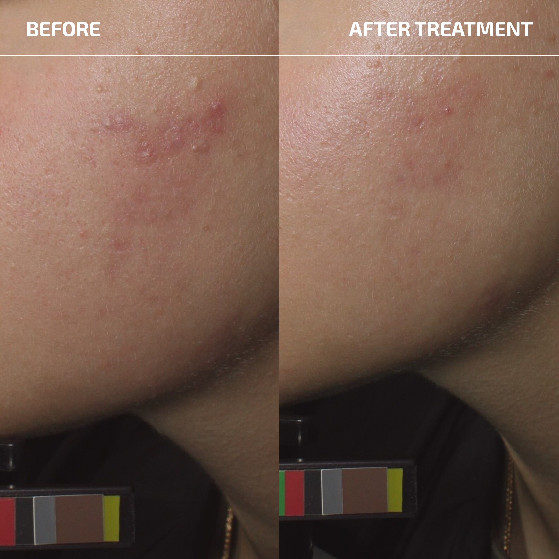 Bacterial Acne Set