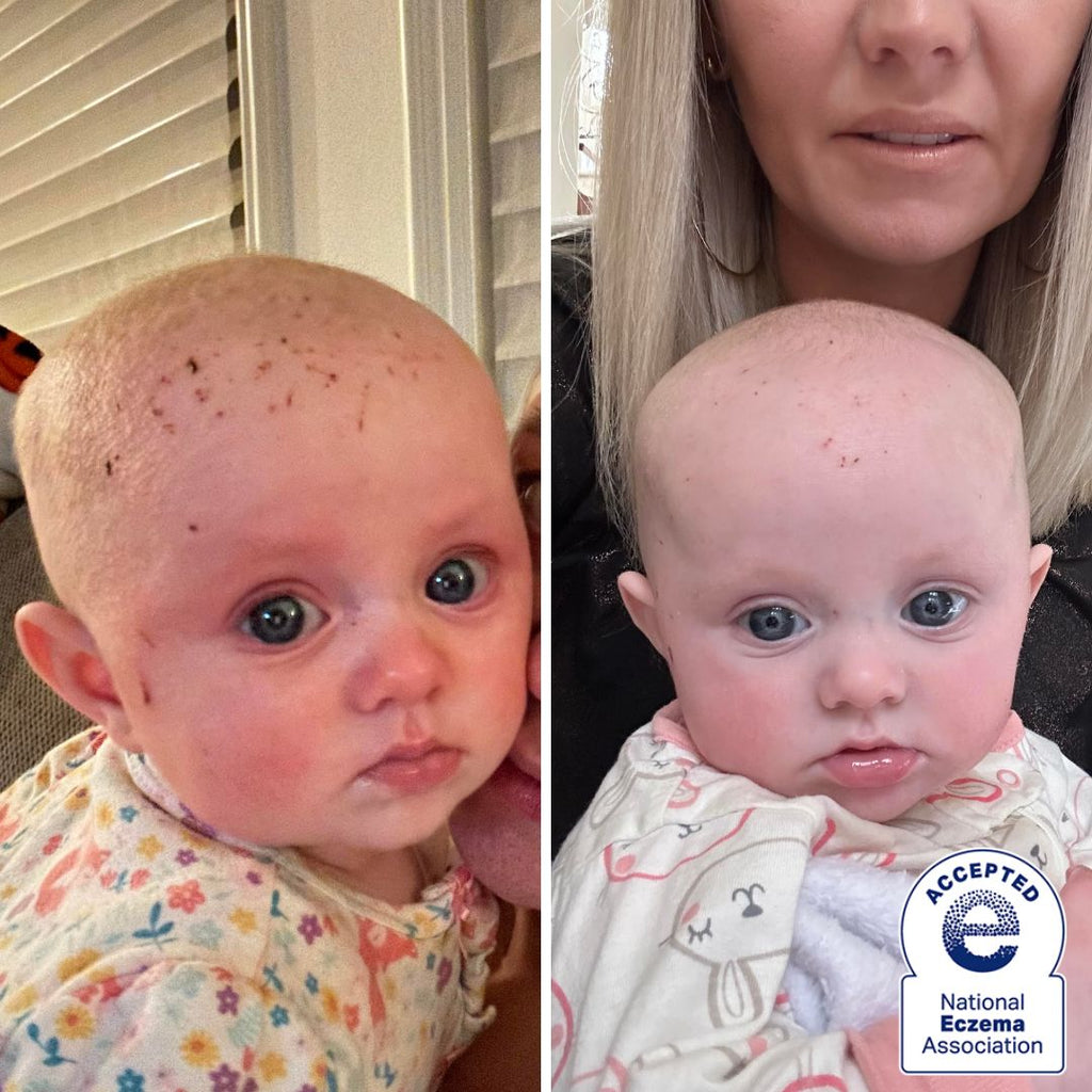 A before and after image  a baby with skin issues on its scalp.