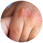 Calm IRRITATION & itch