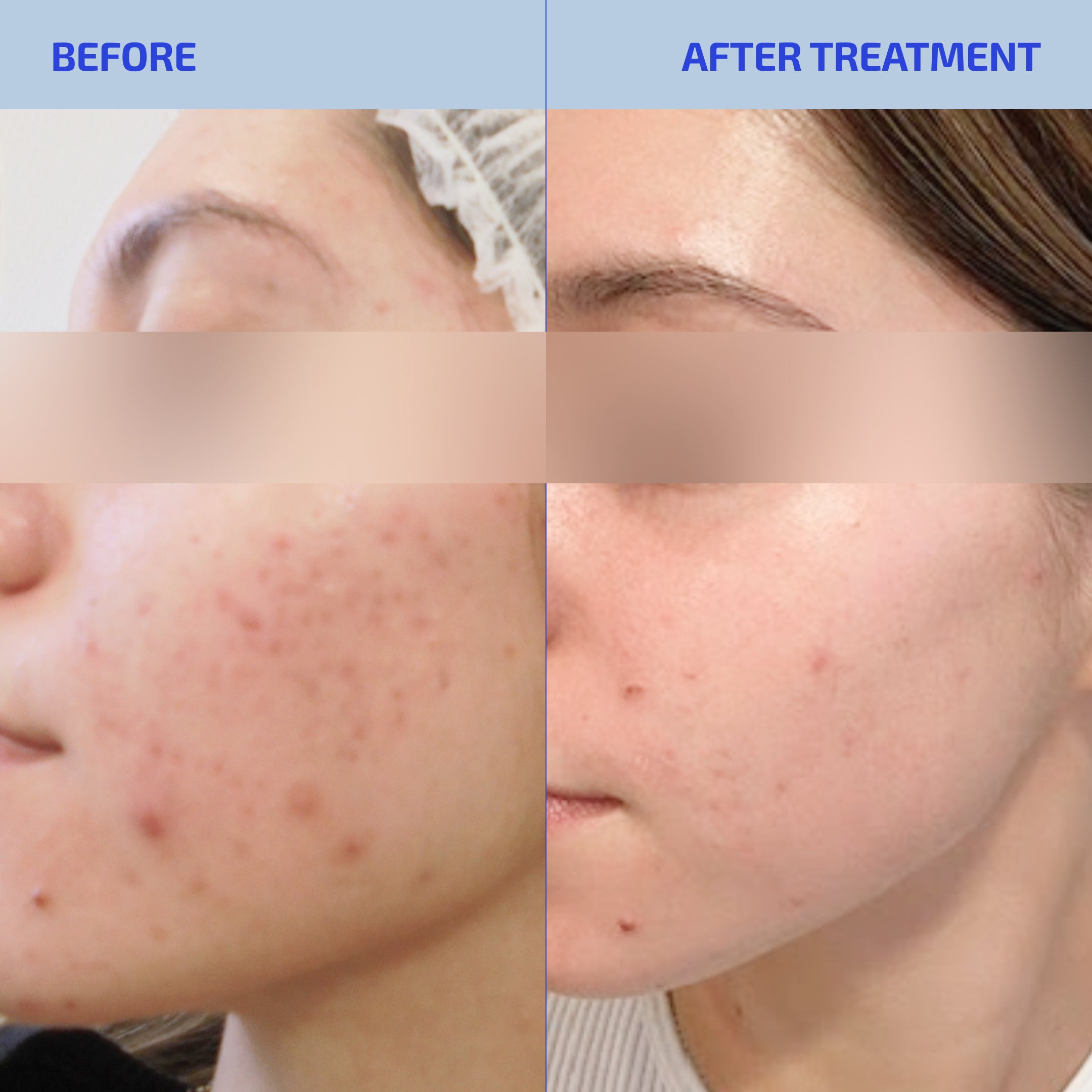 SHAANT MICROBIOME BALANCING TheBioArte SkinDuo® Serum