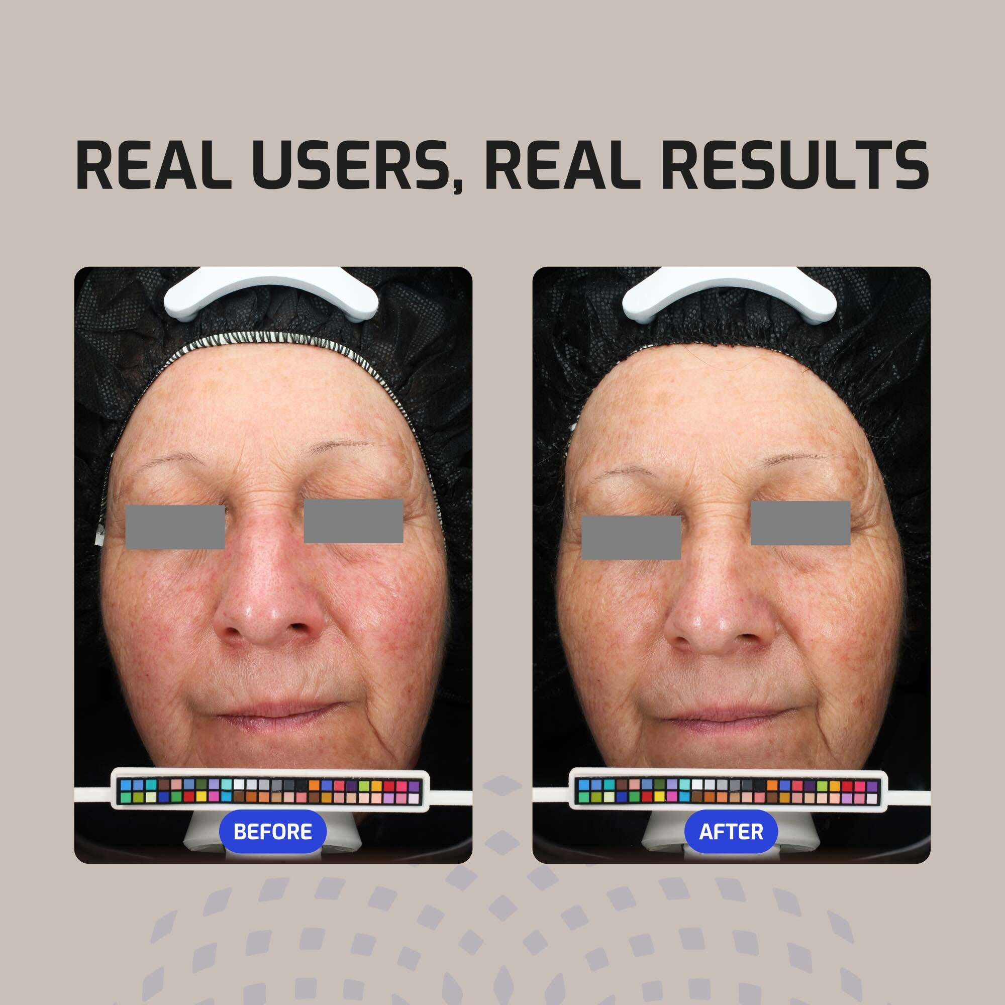 Antü Skin Barrier Serum before after images.