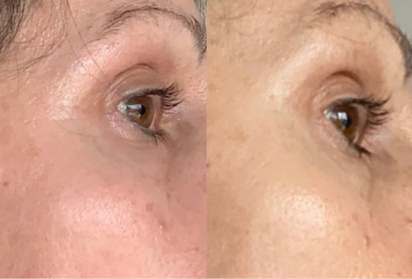 Before and after image of a persons eye and cheek and a progression of their skin clearing up 
