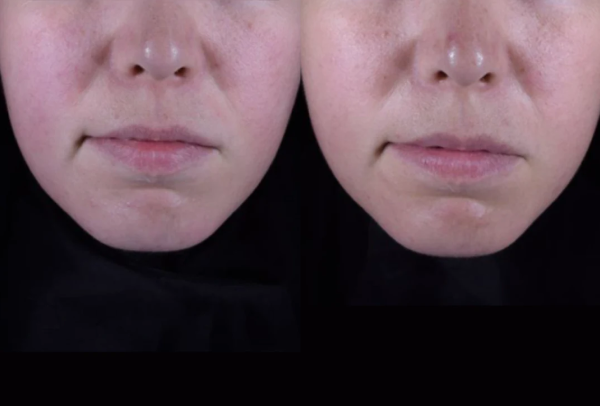 A before and after image of a persons lower face and their progression to clearer skin.