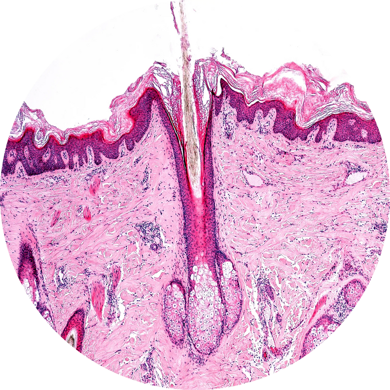 DEAD SKIN CELLS (HYPERKERATINIZATION)