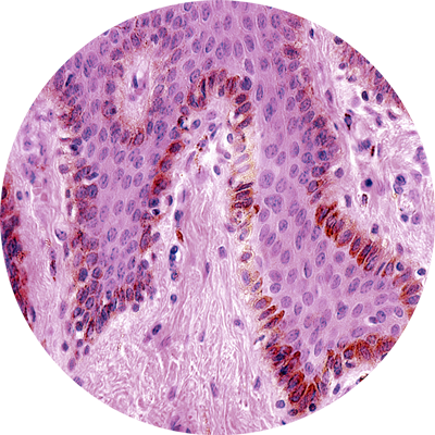 DAMAGE TO MELANOCYTES