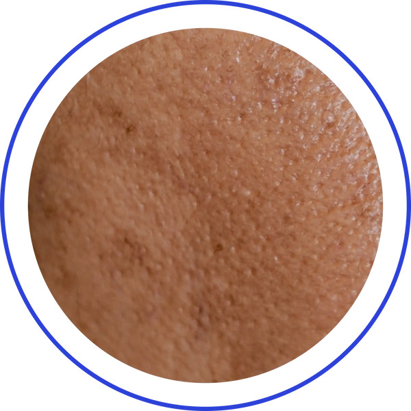 Photoaging Acceleration