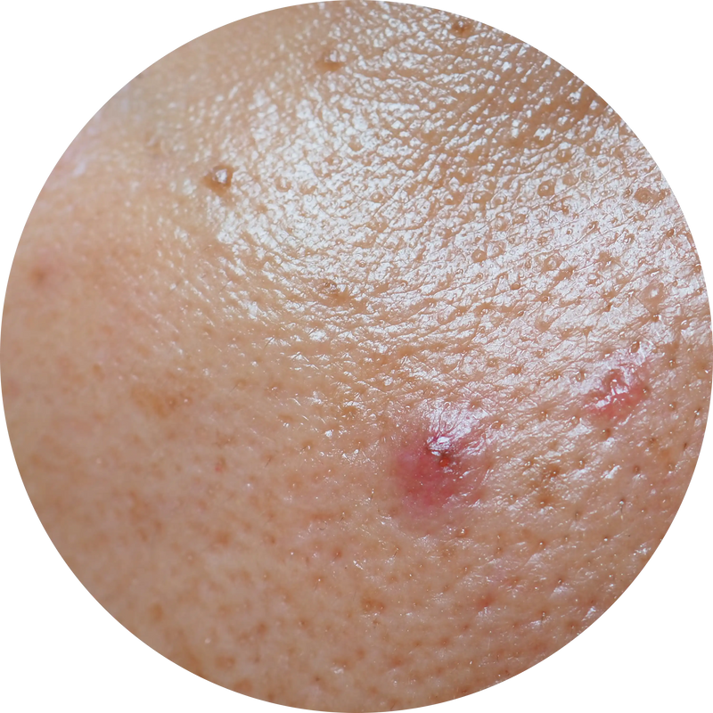 OILY SKIN (HYPERSEBORRHEA)