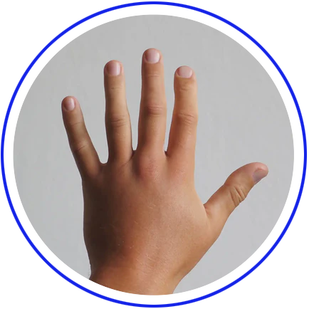 PALMAR-PLANTAR ERYTHRODYSESTHESIA