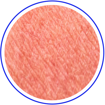 RADIATION INDUCED DERMATITIS