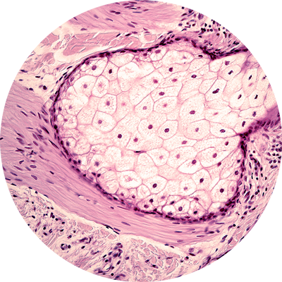 DAMAGE TO SEBOCYTES