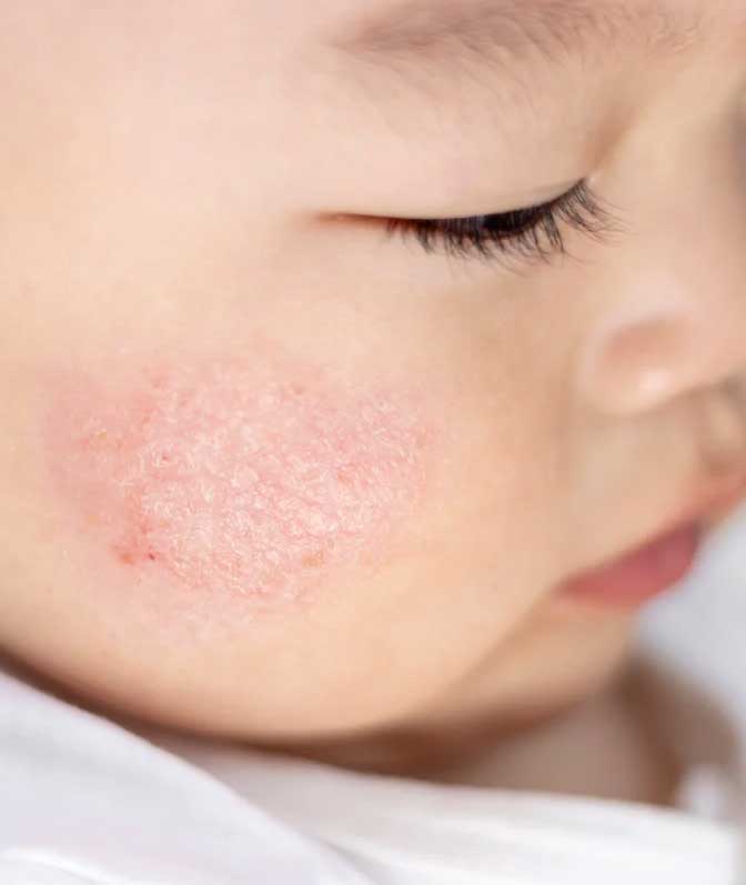 Eczema in Children and Teens– Codex Labs Corp