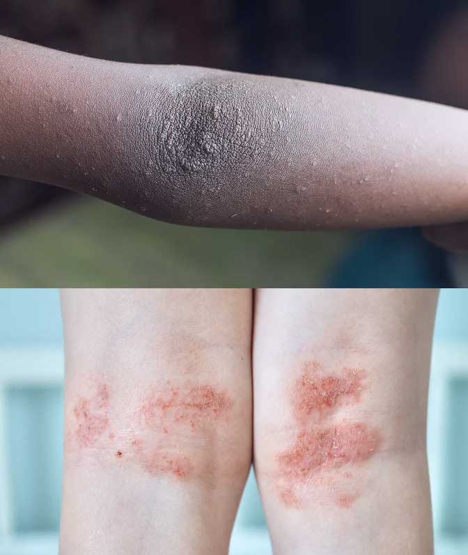 Eczema in Children and Teens– Codex Labs Corp