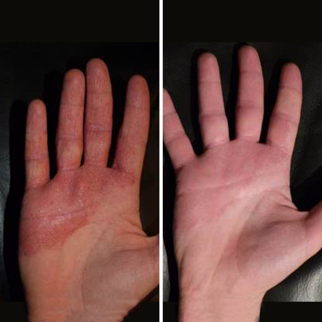 Before and after treatment images of a hand with a skin issue.