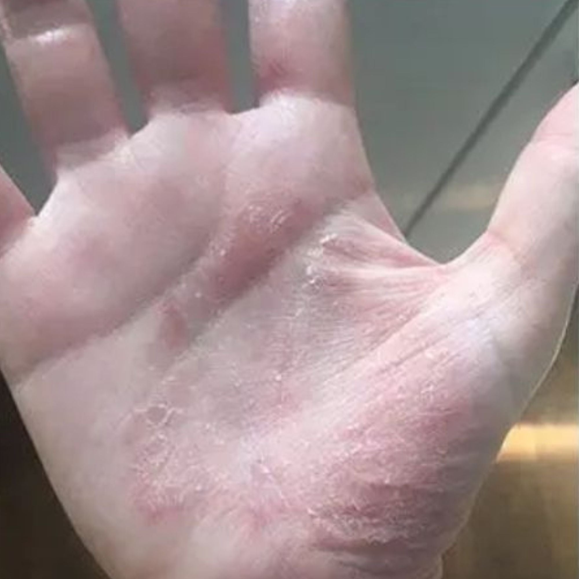 Before treatment