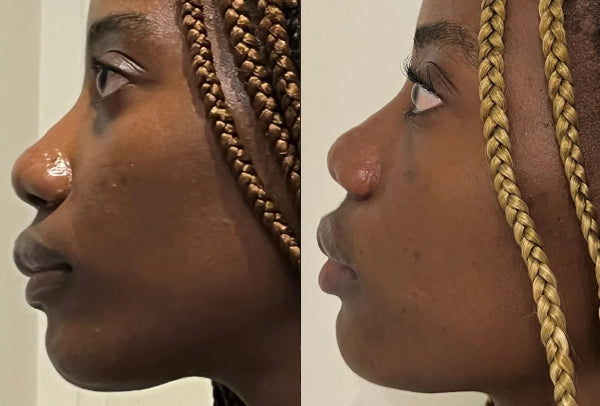Before and after side profile image of a woman with acne issues.